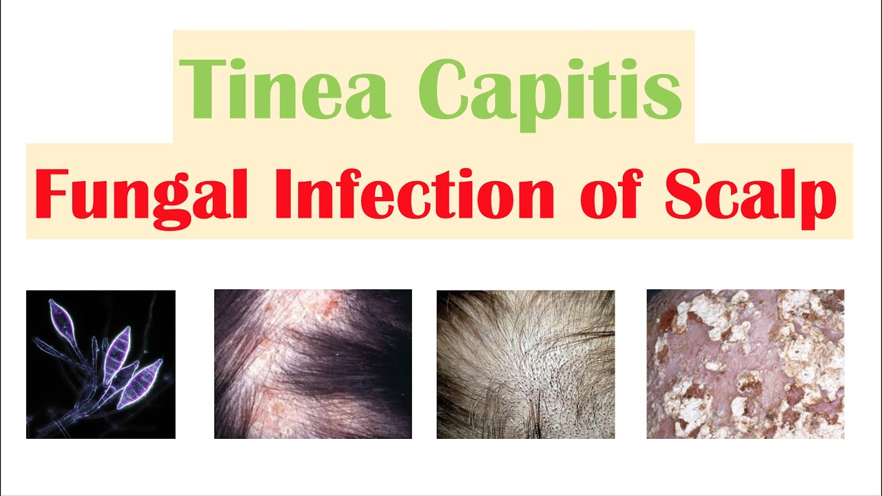 Tinea capitis  DermNet