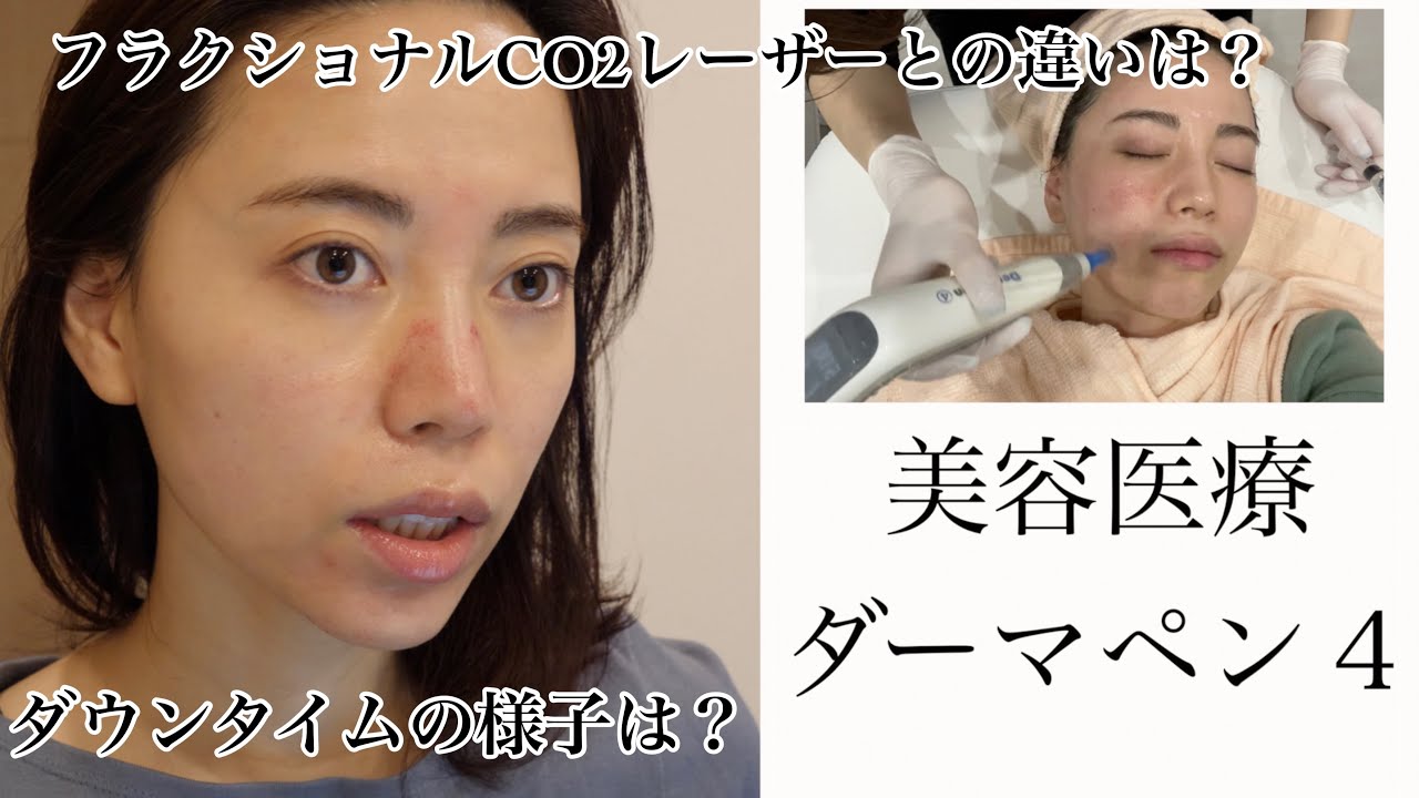 美容医療 毛穴 ニキビ跡改善に効くダーマペン 施術の様子 ダウンタイムの経過 Youtube