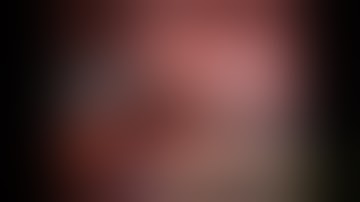 Robotic Lobectomy in 18 Minutes: Step-by-Step, RLLobectomy