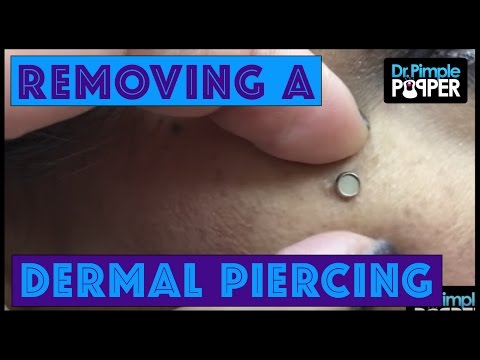 Video: Wie verwijdert dermale piercings?