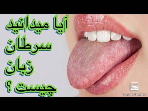 آیا میدانید سرطان زبان چیست؟  و راه درمان ‌جلوگیری از مبتلا شدن به آن