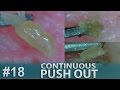 #18 Continuous Removal of Blackheads Close up - Squeezing Blackheads