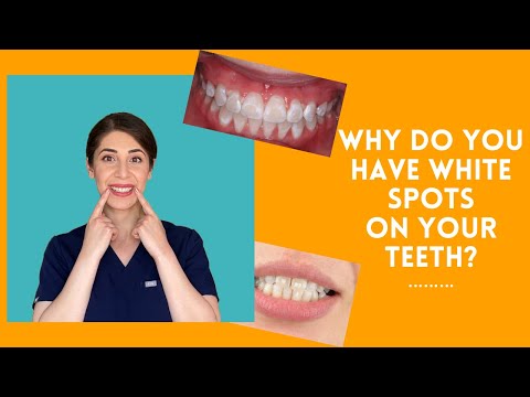 WHAT ARE THE WHITE SPOTS ON YOUR TEETH?