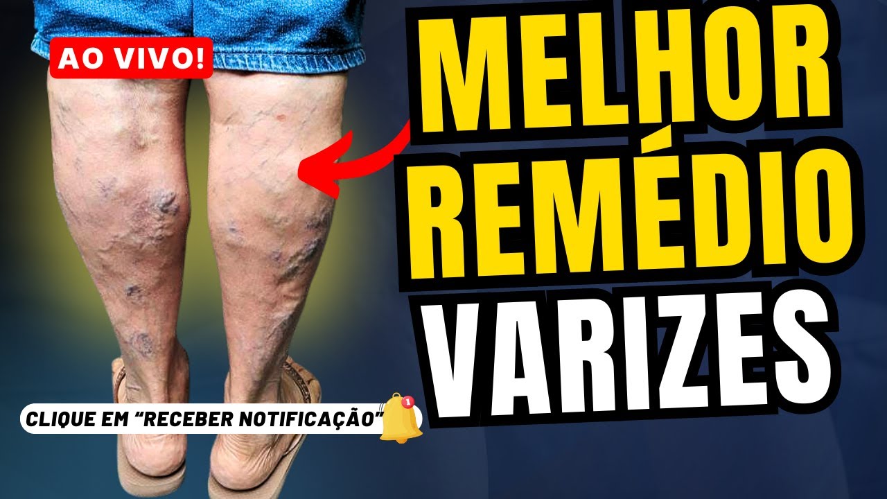 O MELHOR remédio para VARIZES, vasinhos, veias entupidas, varicose ...