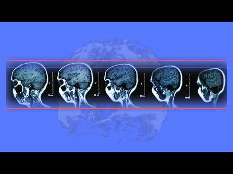 Video: Smegenų Smegenų Skysčio α-sinukleino Oligomerų Kiekis Padidėja Sergant Parkinsono Liga Ir Sergant Demencija Bei Demencija Su Lewy Kūneliais, Palyginti Su Alzheimerio Liga