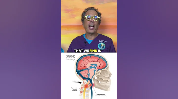 Treating idiopathic intracranial hypertension #braindrain #pressure #atlas #cervicalinstability