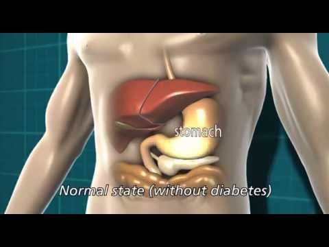diabetes-and-the-affect-on-the-body---animation-video-by-diabetes-uk