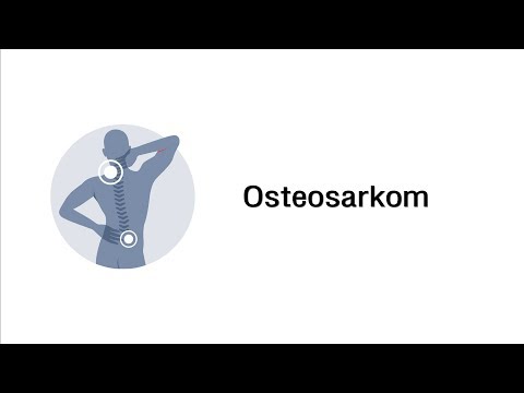 Video: Osteosarkom (Osteosarkom) - Ursachen, Symptome Und Behandlung Des Osteosarkoms
