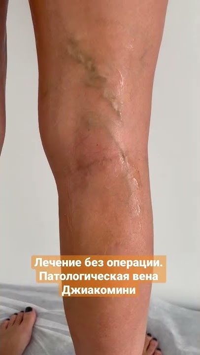 Лечение вены без операции. Вена Джиакомини. Флеболог Москва - YouTube