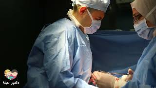 عملية ولادة قيصرية بدون ألم من داخل غرفة العمليات