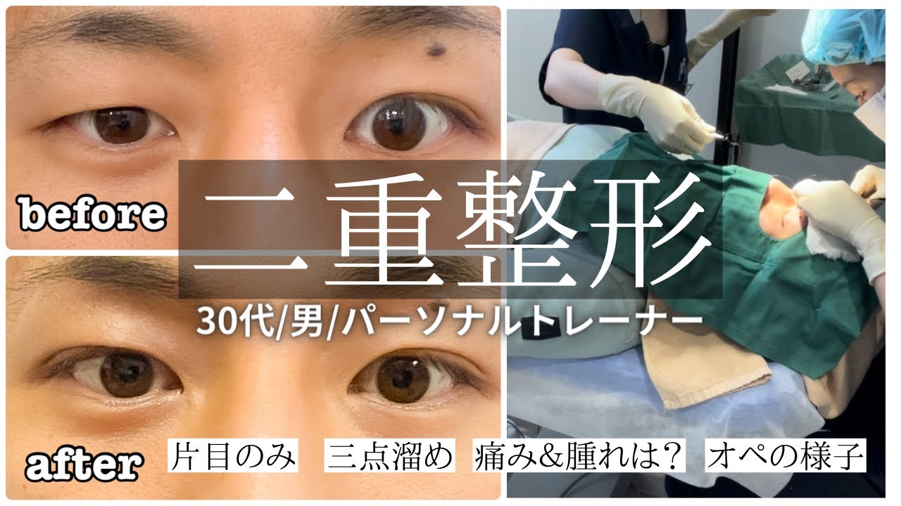 EYE eyelid surgery セレクト美容塾　眼瞼　まぶた　希少 The secret behind Japanese-style double eyelids 🇯🇵 Designed to