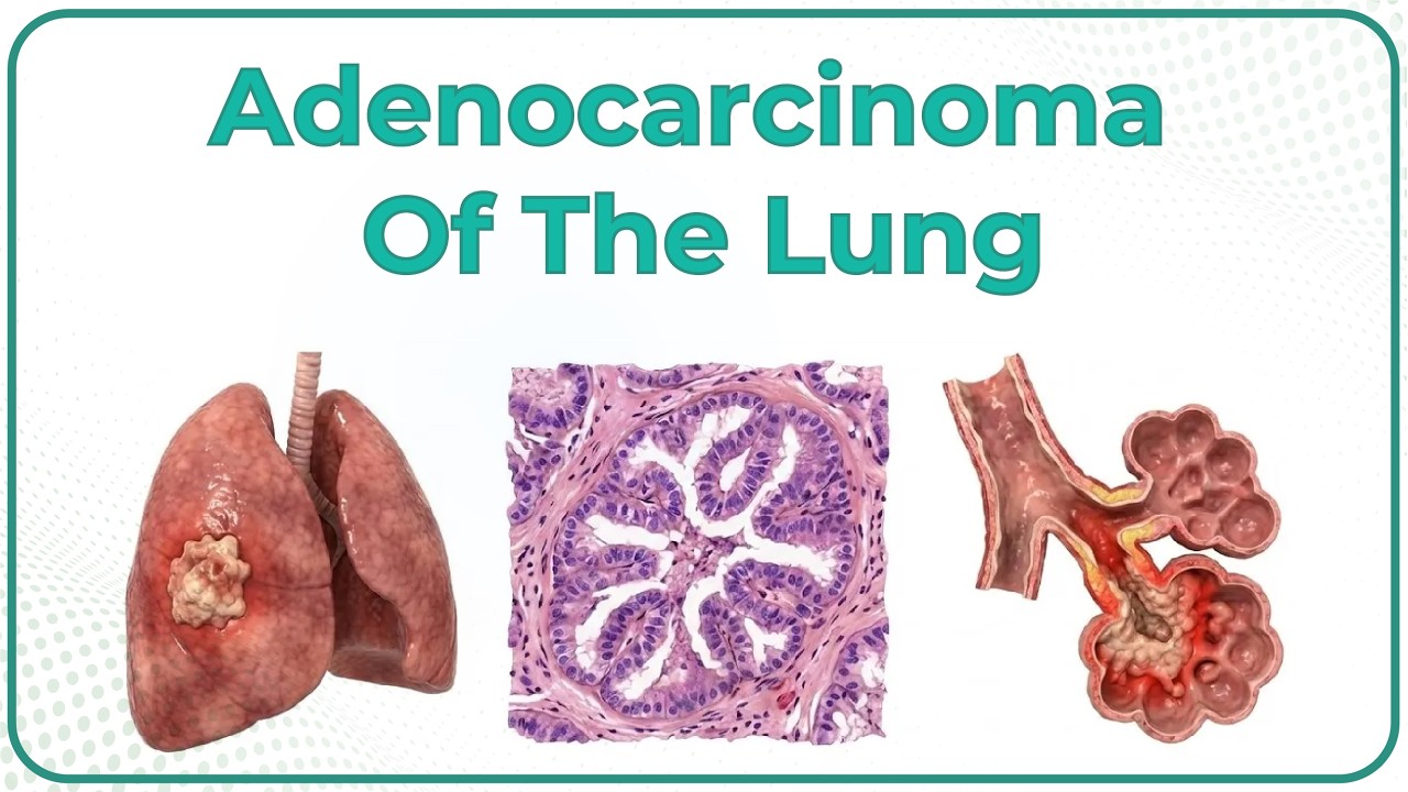 Adenocarcinoma of the lung 🫁 / USMLE - YouTube