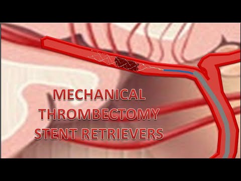 Video: Trombektomi - Jenis Operasi, Indikasi, Hasil
