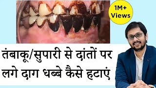 सुपारी / तम्बाकू के दाग धब्बे दांतो पर से कैसे हटाएँ  Teeth whitening at home How to remove stains