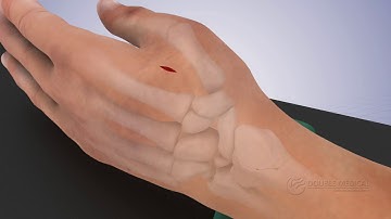 Wrist Joints External Fixation