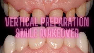 VERTICAL PREPARATION full case Zirconia crowns