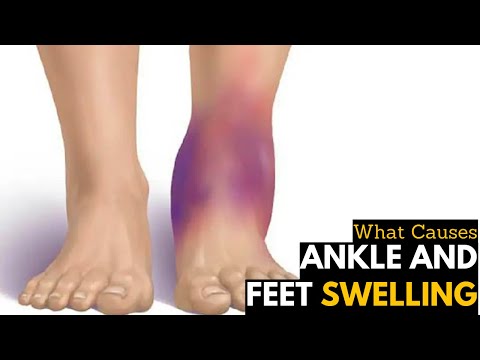 Swollen Ankles and Feet, Causes, Signs and Symptoms, Diagnosis and Treatment.