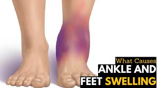 What Causes Ankles Feet Swelling Diagnosis Treatment