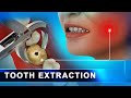 Tooth  extraction