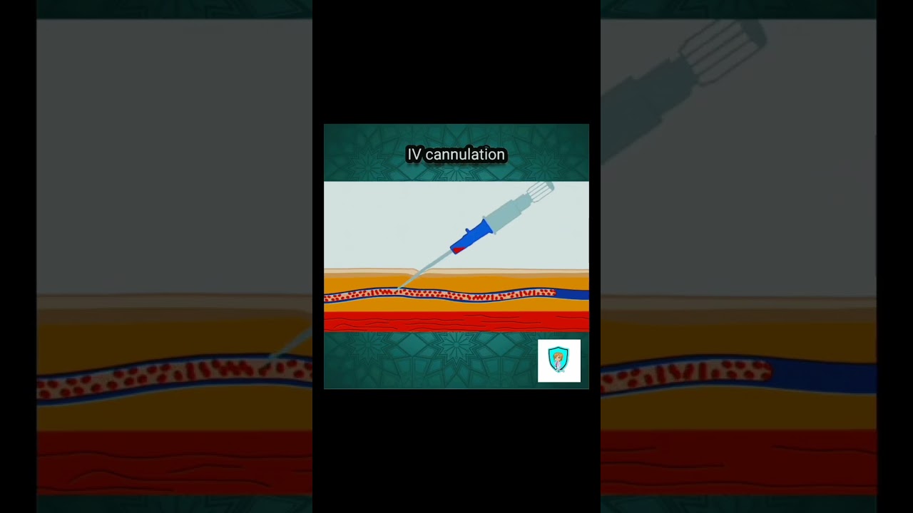 Intravenous (IV) cannulation Animation ||IV Access , Injection 
