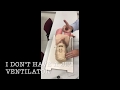 Transtracheal Jet Ventilation