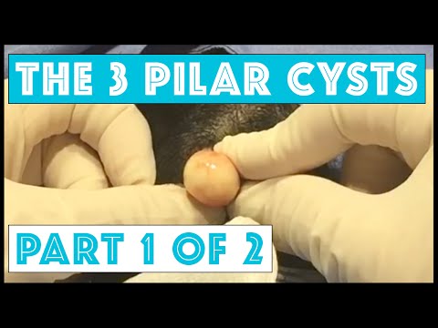 The Story of 3 Pilar Cysts: Part 1 of 2