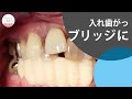 部分入れ歯をブリッジに! 治療過程を全部お見せします! This is How A Dentist Does Dental Bridge