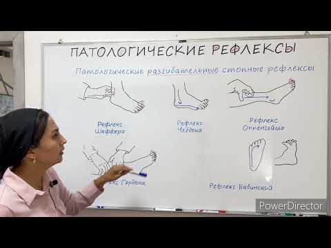 Патологические рефлексы- Pathological reflexes.