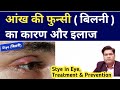 What is Stye?, its Cause Symptoms and Treatment