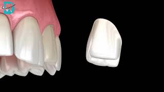 Dental Vneers - فنيير الأسنان