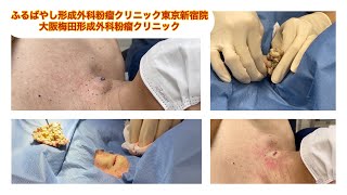 頚部の粉瘤　ブログでも粉瘤について詳しく解説してます。東京皮膚のできものと粉瘤クリニック　ふるばやし形成外科新宿院　大阪梅田形成外科クリニック
