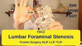 Lumbar Foraminal Stenosis - Fusion Surgery Options Part 2