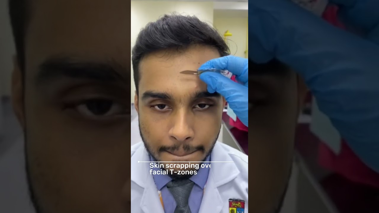 Skin Scraping Technique to Detect Demodex mites Infestations