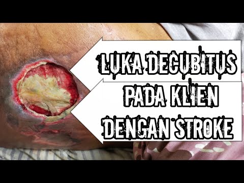 Video: Luka Tidur (Bisul Dekubitus): Penyebab Dan Perawatan