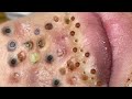 Loan Nguyen Acne Treatment 3n