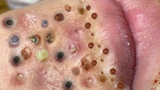 Loan Nguyen Acne Treatment 3n