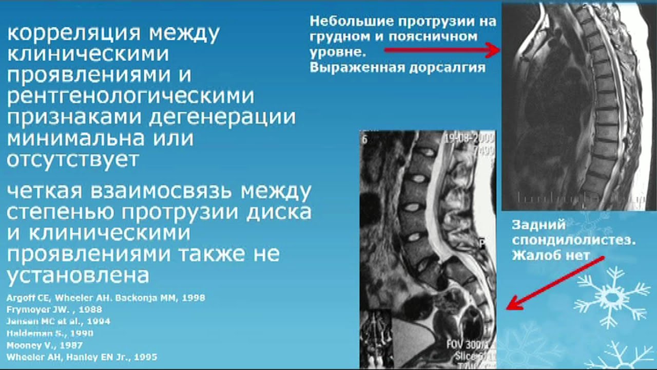 Мр дистрофических изменений пояснично крестцового отдела позвоночника. Остеохондроз позвоночника неврология. Остеохондроз неврология лекция. Неврология остеохондроз поясничного отдела. Неврологические проявления остеохондроза.