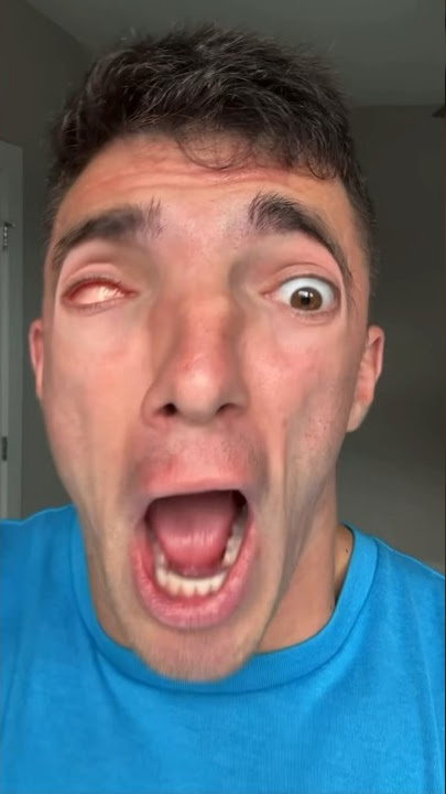 MY EYEBALL POPPED OUT 😳