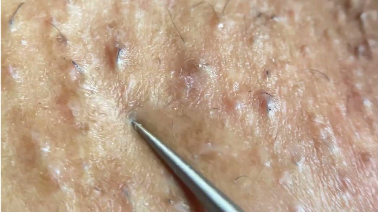 Ingrown Hair Removal Ep20 YouTube