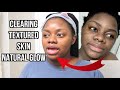 HOW I CLEARED MY TEXTURED SKIN + NEW SKIN CARE ROUTINE