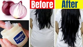 How To Use Vasseline & onion For Hair Grow 2cm Per Day | Hair Growth Home Remedies