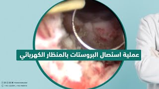 عملية استئصال البروستات بالمنظار الكهربائي