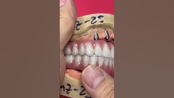 Full Mouth Implants
