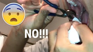 AT HOME TOOTH REMOVAL