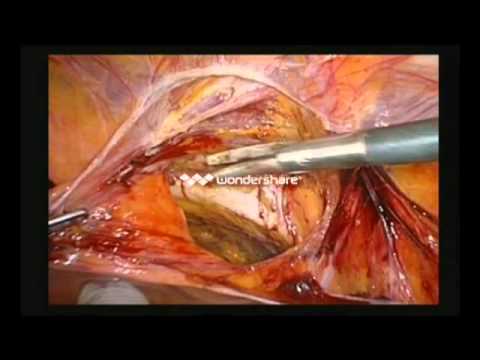 What happens during laparoscopic hernia repair?