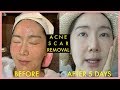 When your acne scar is just not going away! Acne Scar Korean Treatment that works!