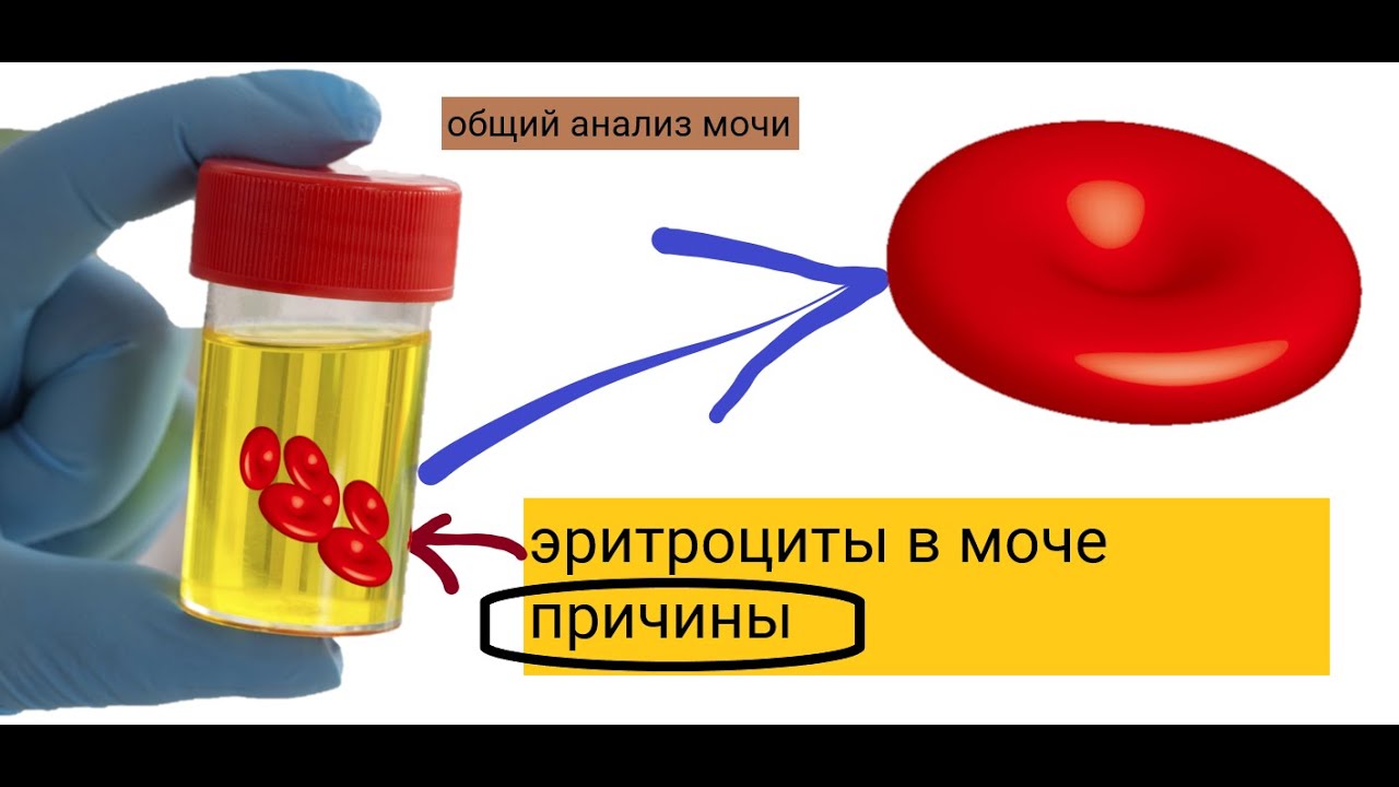 Моче слизь эритроциты