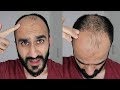 GROWING OUT MY BALDING HAIR - Hair Loss & Why Bald Will ALWAYS Be Better Than BALDING