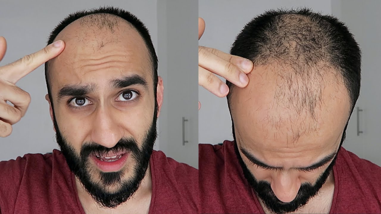 GROWING OUT MY BALDING HAIR - Hair Loss & Why Bald Will ALWAYS Be Better  Than BALDING - YouTube