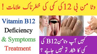 Vitamin B12 Deficiency Symptoms/ How To Increase Vitamin B12/Vitamin B12 Ki Kami Sa Kya Hota Hai